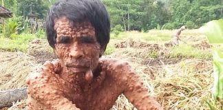 Penuh Benjolan di Sekujur Tubuh